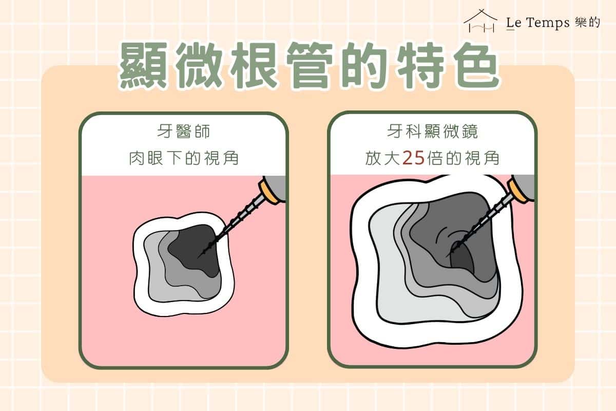 顯微根管的特色