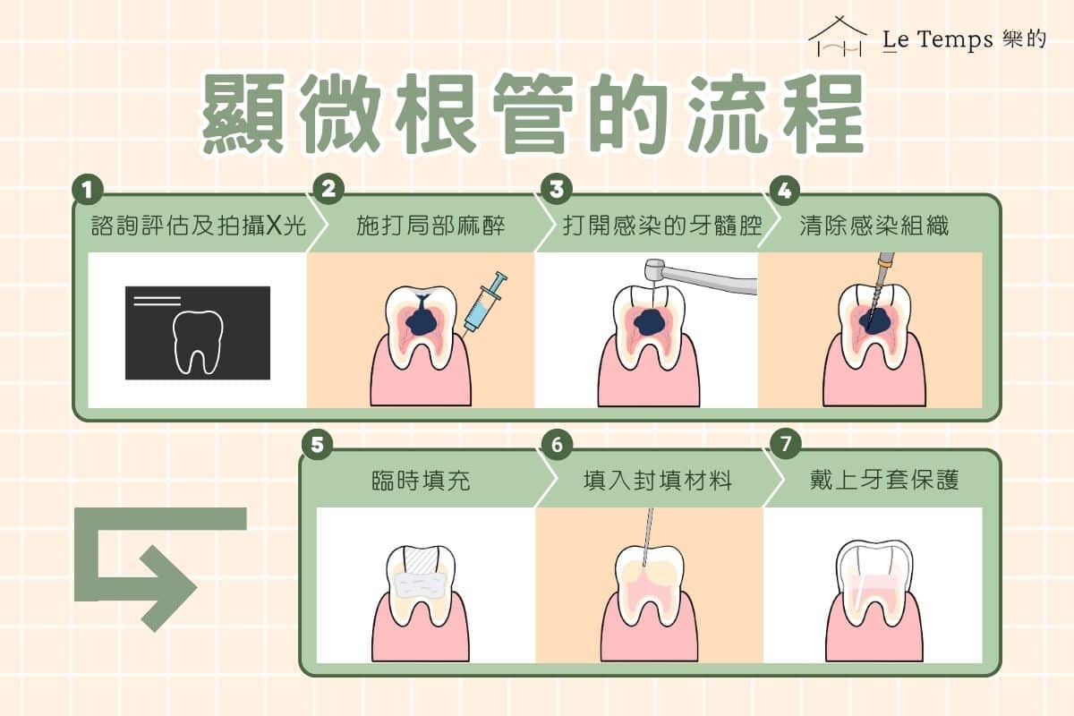 顯微根管治療的流程